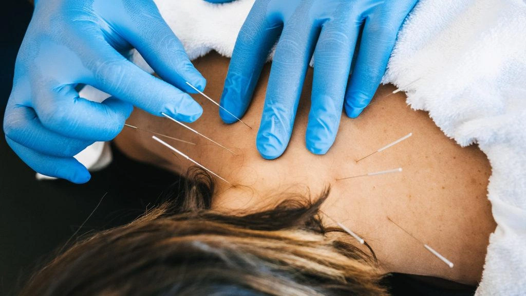 Acupuncture/Dry-Needling Physiotherapy